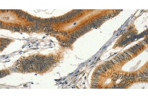 Immunohistochemistry of paraffin-embedded Human colon cancer tissue using CIB1 Polyclonal Antibody at dilution 1:30 (CIB1 抗体)