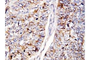 IHC-P: Cdc25B antibody testing of human lung cancer tissue (CDC25B 抗体  (AA 541-559))