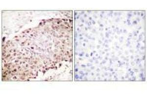 Immunohistochemistry analysis of paraffin-embedded human breast carcinoma tissue using Sumo1 antibody. (SUMO1 抗体  (N-Term))