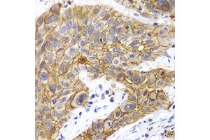 Immunohistochemistry of paraffin-embedded human lung cancer using CLDN1 antibody. (Claudin 1 抗体)