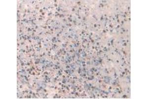 IHC-P analysis of Human Rectum Cancer Tissue, with DAB staining. (Amylin/DAP 抗体)