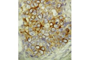 Anti-Caspase-6(P18) antibody, IHC(P) IHC(P): Human Mammary Cancer Tissue