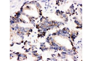 IHC-P: IRAK2 antibody testing of human lung cancer tissue