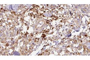 ABIN6276882 at 1/100 staining Human Melanoma tissue by IHC-P. (TFF1 抗体  (Internal Region))
