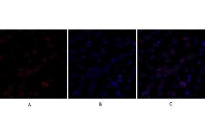Immunofluorescence analysis of human breast cancer tissue. (DNMT3B 抗体  (AA 1-80))