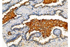 ABIN6265001 and ABIN6276451 at 1/100 staining Human colorectal cancer by IHC-P.