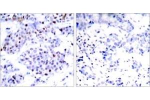 Immunohistochemistry analysis of paraffin-embedded human breast carcinoma tissue, using STAT6 (Ab-645) Antibody. (STAT6 抗体  (AA 612-661))