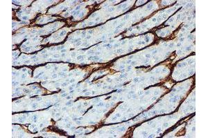 Immunohistochemical staining of paraffin-embedded Carcinoma of Human liver tissue using anti-PECAM1 mouse monoclonal antibody. (CD31 抗体)