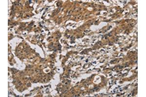 The image is immunohistochemistry of paraffin-embedded Human gastric cancer tissue using ABIN7128636(BCL2L12 Antibody) at dilution 1/20. (BCL2L12 抗体)