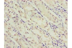 Immunohistochemistry of paraffin-embedded human gastric cancer using ABIN7170275 at dilution of 1:100 (GPR172A 抗体  (AA 217-276))