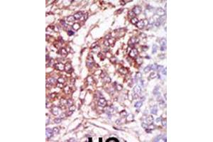 Formalin-fixed and paraffin-embedded human cancer tissue reacted with the primary antibody, which was peroxidase-conjugated to the secondary antibody, followed by DAB staining. (CSNK1G3 抗体  (C-Term))