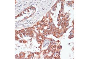 Immunohistochemistry of paraffin-embedded human lung cancer using TI antibody (ABIN6130725, ABIN6149146, ABIN6149147 and ABIN6214431) at dilution of 1:100 (40x lens). (TIAM1 抗体  (AA 1392-1591))