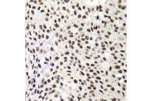 Immunohistochemistry of paraffin-embedded human lung cancer using NELFE antibody at dilution of 1:100 (x40 lens). (RDBP 抗体)