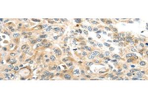Immunohistochemistry of paraffin-embedded Human esophagus cancer tissue using TMPRSS4 Polyclonal Antibody at dilution 1:50 (TMPRSS4 抗体)