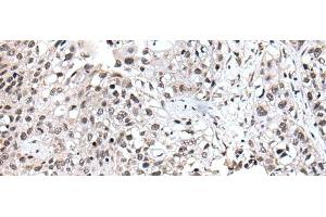 Immunohistochemistry of paraffin-embedded Human lung cancer tissue using UBE2E3 Polyclonal Antibody at dilution of 1:40(x200) (UBE2E3 抗体)