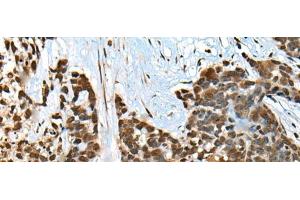 Immunohistochemistry of paraffin-embedded Human thyroid cancer tissue using CCDC12 Polyclonal Antibody at dilution of 1:60(x200) (CCDC12 抗体)