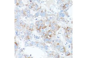 Immunohistochemistry of paraffin-embedded human liver cancer using TFR2 antibody (ABIN6128863, ABIN6149063, ABIN6149064 and ABIN6225172) at dilution of 1:100 (40x lens). (Transferrin Receptor 2 抗体  (AA 582-801))
