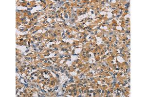 Immunohistochemistry of Human thyroid cancer using GPM6A Polyclonal Antibody at dilution of 1:50 (GPM6A 抗体)