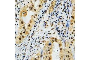 Immunohistochemical analysis of PRPF39 staining in human lung cancer formalin fixed paraffin embedded tissue section. (PRPF39 抗体)