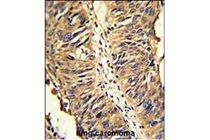 Formalin-fixed and paraffin-embedded human lung carcinoma reacted with PDIA3 Antibody (Center), which was peroxidase-conjugated to the secondary antibody, followed by DAB staining.