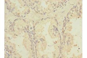 Immunohistochemistry of paraffin-embedded human prostate cancer using ABIN7173811 at dilution of 1:100
