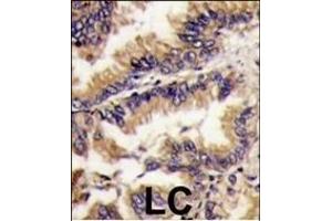 Forlin-fixed and paraffin-embedded hun lung carcino tissue reacted with PK1 Antibody (Center) (ABIN391367 and ABIN2841384) , which was peroxidase-conjugated to the secondary antibody, followed by DAB staining. (ERK2 抗体  (AA 154-183))