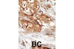 Formalin-fixed and paraffin-embedded human cancer tissue reacted with the primary antibody, which was peroxidase-conjugated to the secondary antibody, followed by AEC staining. (MAP3K14 抗体  (AA 119-148))