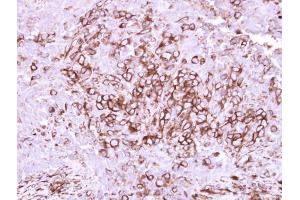 IHC-P Image Immunohistochemical analysis of paraffin-embedded human breast cancer, using CD40, antibody at 1:250 dilution. (CD40 抗体  (Center))
