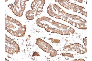 Formalin-fixed, paraffin-embedded human Small Intestinal Carcinoma stained with Villin-Monospecific Recombinant Mouse Monoclonal Antibody (rVIL1/1325). (Recombinant Villin 1 抗体  (AA 179-311))