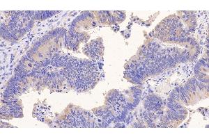Detection of PIIINP in Human Colorectal cancer Tissue using Monoclonal Antibody to Procollagen III N-Terminal Propeptide (PIIINP) (PIIINP 抗体)