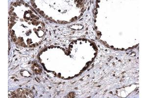 IHC-P Image UBE3A antibody detects UBE3A protein at nucleus on human ovarian carcinoma by immunohistochemical analysis. (ube3a 抗体)
