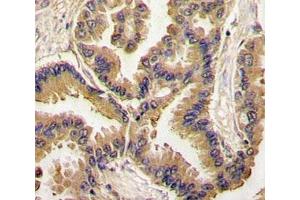 IHC analysis of FFPE human lung carcinoma tissue stained with BMP6 antibody (BMP6 抗体  (AA 25-55))
