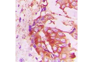 Immunohistochemical analysis of RhoH staining in human lung cancer formalin fixed paraffin embedded tissue section. (RHOH 抗体  (C-Term))