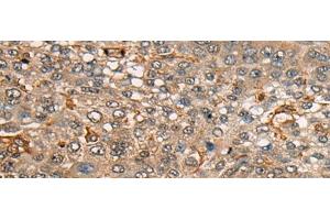 Immunohistochemistry of paraffin-embedded Human liver cancer tissue using CDT1 Polyclonal Antibody at dilution of 1:45(x200) (CDT1 抗体)