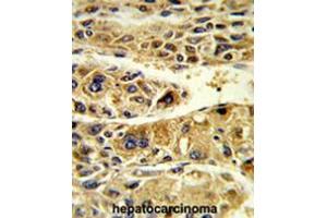 Formalin-fixed and paraffin-embedded human hepatocarcinoma reacted with ADH6 Antibody (Center), which was peroxidase-conjugated to the secondary antibody, followed by DAB staining. (ADH6 抗体  (Middle Region))