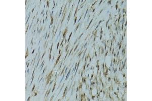 Immunohistochemistry of paraffin-embedded human uterine cancer using GABPA antibody (ABIN6127940, ABIN6140889, ABIN6140892 and ABIN6224475) at dilution of 1:100 (40x lens). (GABPA 抗体  (AA 1-260))