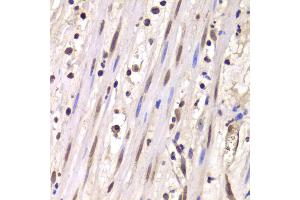 Immunohistochemistry of paraffin-embedded human mammary cancer using LSM4 antibody (ABIN5973492) at dilution of 1/100 (40x lens). (LSM4 抗体)