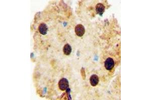 Immunohistochemistry analysis in formalin fixed and paraffin embedded human skin carcinoma reacted with OAZ2 Antibody (C-term) followed by peroxidase conjugation of the secondary antibody and DAB staining. (OAZ2 抗体  (C-Term))