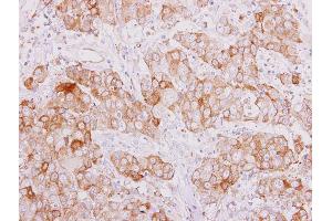 IHC-P Image SMAD9 antibody detects SMAD9 protein at cytoplasm on human breast carcinoma by immunohistochemical analysis. (SMAD9 抗体)