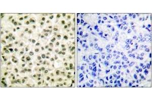 Immunohistochemistry analysis of paraffin-embedded human breast carcinoma tissue, using Ku70/80 Antibody. (Ku70/80 (AA 683-732) 抗体)