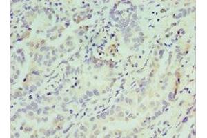 Immunohistochemistry of paraffin-embedded human lung cancer using ABIN7148809 at dilution of 1:100 (ATF7 抗体  (AA 1-117))