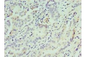 Immunohistochemistry of paraffin-embedded human lung cancer using ABIN7148809 at dilution of 1:100 (AFT7 抗体  (AA 1-117))