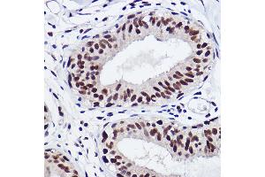 Immunohistochemistry of paraffin-embedded human breast cancer using GTF2I Rabbit mAb (ABIN1682306, ABIN3015201, ABIN3015202 and ABIN7101319) at dilution of 1:100 (40x lens). (GTF2I 抗体)