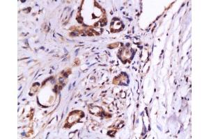 Formalin-fixed and paraffin embedded human gastric carcinoma labeled with Anti-CD105 Polyclonal Antibody , Unconjugated at 1:200, followed by conjugation to the secondary antibody and DAB staining