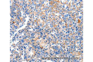 Immunohistochemistry of Human ovarian cancer using HCN2 Polyclonal Antibody at dilution of 1:80 (HCN2 抗体)