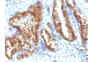 Formalin-fixed, paraffin-embedded human Prostate Carcinoma stained with AMACR / p504S Rabbit Polyclonal Antibody. (AMACR 抗体)