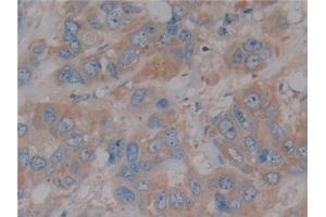 Detection of NOS2 in Human Breast cancer Tissue using Polyclonal Antibody to Nitric Oxide Synthase 2, Inducible (NOS2) (NOS2 抗体  (AA 533-696))