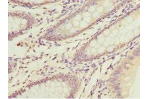 Immunohistochemistry of paraffin-embedded human colon cancer using ABIN7150497 at dilution of 1:100 (DNAJA2 抗体  (AA 233-412))