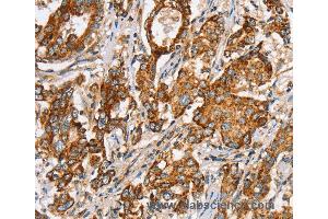 Immunohistochemistry of Human liver cancer using SLC5A11 Polyclonal Antibody at dilution of 1:35 (Solute Carrier Family 5 (Sodium/inositol Cotransporter), Member 11 (SLC5A11) 抗体)