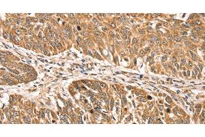 Immunohistochemistry of paraffin-embedded Human lung cancer using RPLP2 Polyclonal Antibody at dilution of 1:35 (RPLP2 抗体)